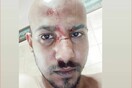 Ναύπακτος: Ξυλοκόπησαν νεαρό και τον εγκατέλειψαν αιμόφυρτο - Ομοφοβικά κίνητρα καταγγέλλει ο ίδιος