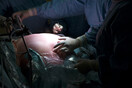 Η βαριατρική χειρουργική μειώνει σημαντικά τους πρόωρους θανάτους - Τα ευρήματα 40ετούς έρευνας 