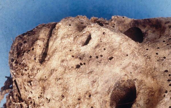 Αρχαιολόγοι και βιολόγοι μόλις αποκάλυψαν το αρχαιότερο θύμα ηπατίτιδας Β στον κόσμο