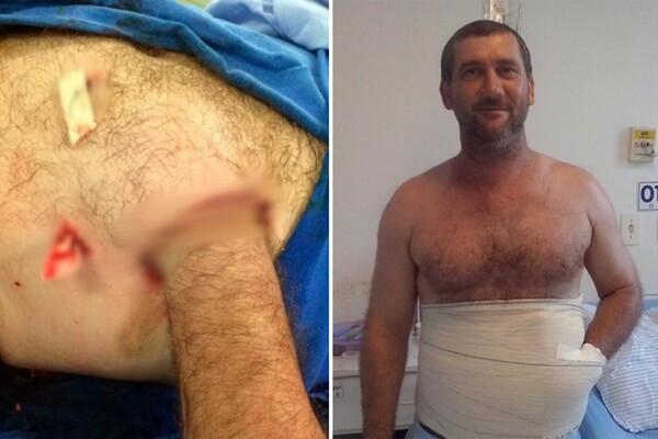 Οι γιατροί έσωσαν το χέρι ενός Βραζιλιάνου ράβοντάς το μέσα στην κοιλιά του