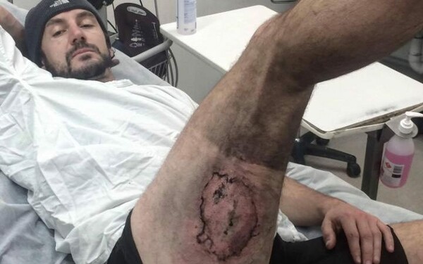 Αυστραλία: Ποδηλάτης υπέστη σοβαρό έγκαυμα όταν πήρε φωτιά το iPhone στην τσέπη του