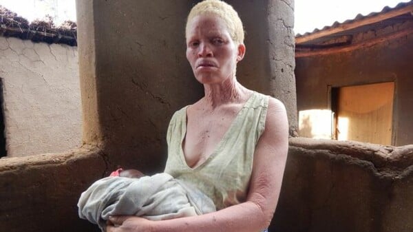 Μαλάουι: Η συγκλονιστική εξομολόγηση μιας γυναίκας αλμπίνο που φοβάται ακόμη και να κοιμηθεί