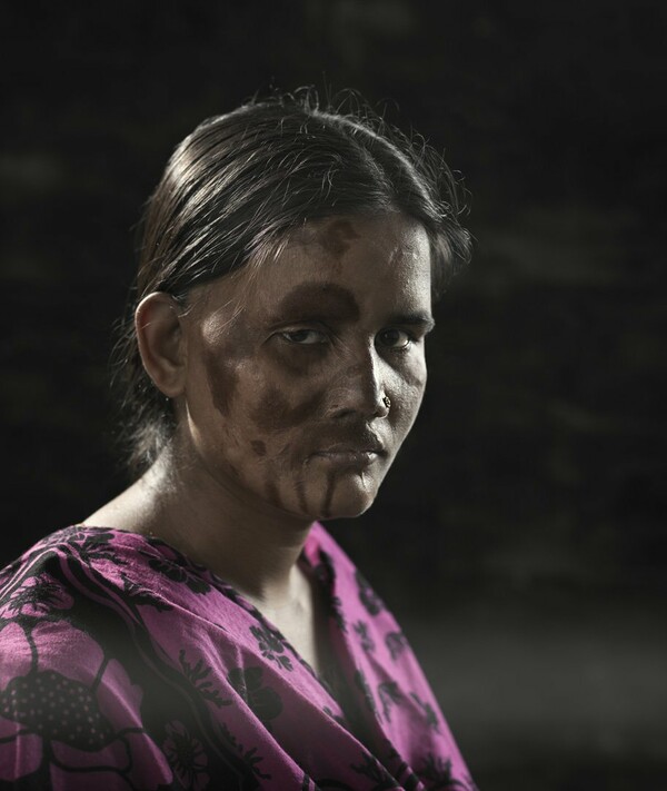 Η Umma δέχτηκε επίθεση με οξύ από τον σύζυγό της όταν ήταν μόλις 15