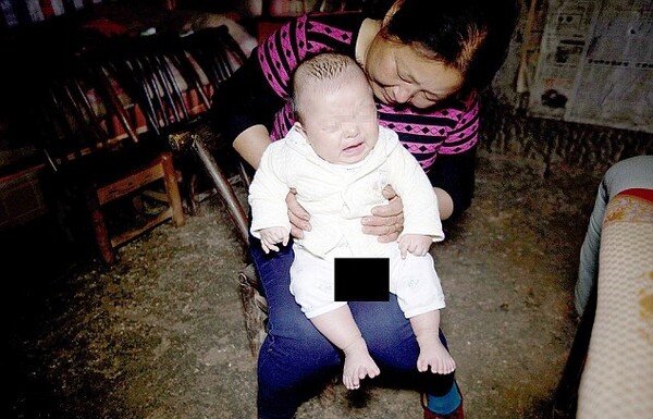 Μωρό στην Κίνα γεννήθηκε με 15 δάχτυλα στα χέρια και 16 στα πόδια