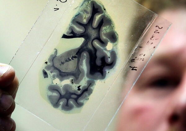 Έλληνες και Βρετανοί επιστήμονες κατάφεραν να "φρενάρουν" την ανάπτυξη της νόσου Αλτσχάιμερ