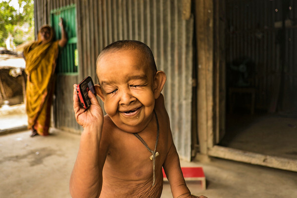 Η ιστορία του 4χρονου από το Μπαγκλαντές που λόγω της σπάνιας ασθένειάς του δεν μοιάζει με τα παιδιά της ηλικίας του