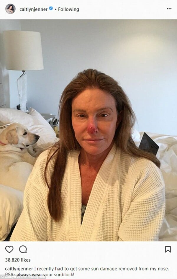 Η Κέιτλιν Τζένερ αποκάλυψε με μια σοκαριστική φωτογραφία τον καρκίνο του δέρματος