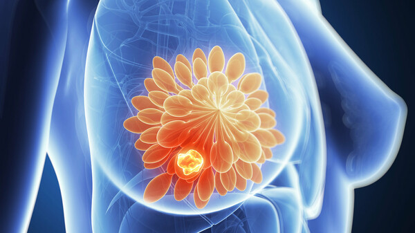 Ένα νέο τεστ υπόσχεται να αντικαταστήσει τη χημειοθεραπεία στις γυναίκες με καρκίνο μαστού
