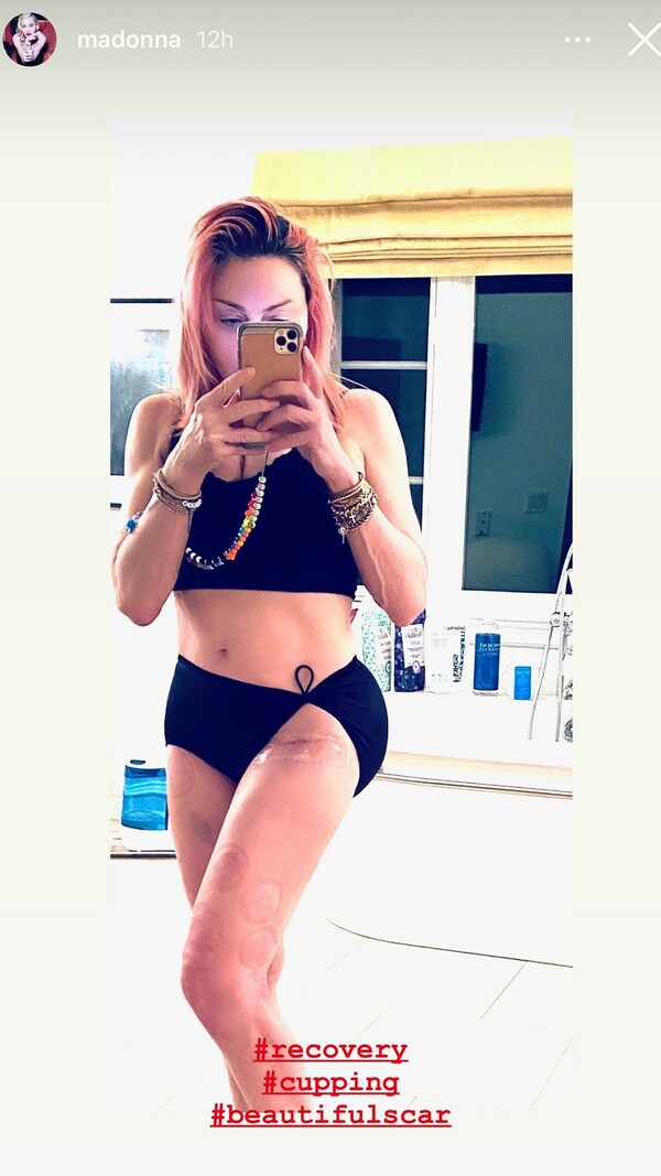 Η Μαντόνα δείχνει τις ουλές στο χειρουργημένο πόδι της - Οι αναρτήσεις στο Instagram