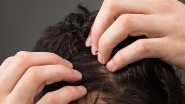 Τριχοτιλλομανία: Η διαταραχή κατά την οποία τραβάς τις τρίχες από το κεφάλι σου