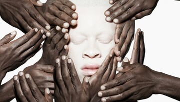 Μοντέλα με αλμπινισμό θέτουν νέα όρια στη μόδα