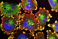 ΚΑΡΚΙΝΟΣ ΟΥΡΟΔΟΧΟΣ ΚΥΣΤΗ ΑΧΡΩΜΑΤΟΨΙΑ