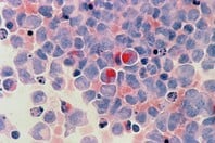 ΚΑΡΚΙΝΟΣ ΝΕΟΙ ΑΥΞΗΣΗ ΑΓΓΛΙΑ