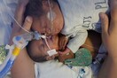 Γεννήθηκε πρόωρα, κινδύνευσε να πεθάνει αλλά τον έσωσε η αγκαλιά του δίδυμου αδερφού του