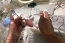 Το μικρότερο μωρό του κόσμου γεννήθηκε 258 γραμμάρια και βγήκε από την εντατική μετά από έξι μήνες
