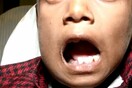 Γιατροί αφαίρεσαν 526 δόντια από το στόμα ενός 7χρονου αγοριού στην Ινδία