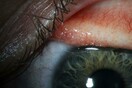 Η πρώτη καταγεγραμμένη περίπτωση στα ιατρικά χρονικά με μάτι γυναίκας που γέμισε παρασιτικά σκουλήκια