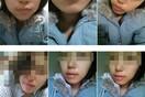 Πλαστική εγχείριση για μόνιμο "Duck Face"!