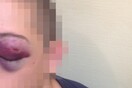 Καταγγελίες για βασανισμούς συλληφθέντων από αστυνομικούς, στα Εξάρχεια