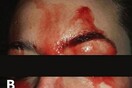 Μυστήριο με 21χρονη Ιταλίδα που αιμορραγεί από το πρόσωπο και τα χέρια αλλά κανείς δεν μπορεί να εξηγήσει γιατί