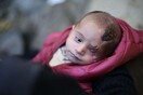 Συγκλονίζει το μωρό στη Συρία που έχασε το μάτι του σε βομβαρδισμό