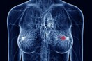Το οικογενειακό ιστορικό καρκίνου στον μαστό αυξάνει τον κίνδυνο επιθετικών όγκων