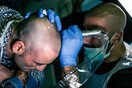 Scalp micropigmentation: Γιατί πολλοί φαλακροί άντρες αποφάσισαν να το δοκιμάσουν