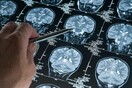 Διεθνής έρευνα: Αυξημένος ο κίνδυνος Αλτσχάιμερ για όσους κάνουν συχνά αρνητικές σκέψεις