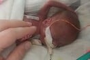 The world's most premature baby has celebrated his first birthday after beating 0% odds of surviving