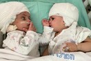 Δίδυμες αδελφές, που γεννήθηκαν ενωμένες στο κεφάλι, είδαν για πρώτη φορά η μία την άλλη