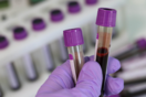 Τεστ αίματος ανιχνεύει 50 τύπους καρκίνου- Πώς μπορεί να επιταχύνει τη διάγνωση 