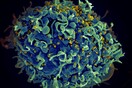 Eλπίδες για θεραπεία του HIV μετά την επιτυχή αφαίρεση του ιού από κύτταρα 