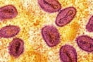 Το πιο επιθετικό στέλεχος της mpox εντοπίστηκε σε κάτοικο της Καλιφόρνια – Χωρίς επαφή με το εξωτερικό