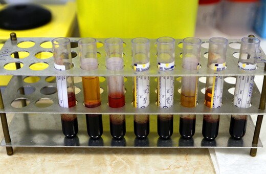 «Απαράδεκτες καθυστερήσεις» στην διάγνωση HIV - Τι καταγγέλλει η «Θετική Φωνή»