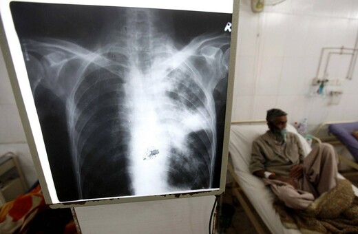 Το lockdown «παραλύει» την καταπολέμηση της φυματίωσης - Φόβοι για 1,4 εκατ. επιπλέον νεκρούς