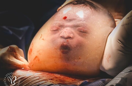 Η πολύ σπάνια γέννα μωρού μέσα στον αμνιακό σάκο