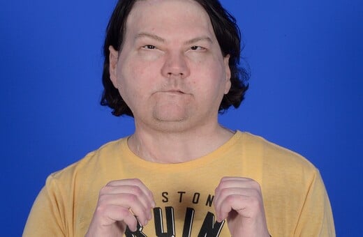 Η πρώτη επιτυχημένη μεταμόσχευση προσώπου και χεριών παγκοσμίως: «Νιώθω αληθινά ευγνώμων»