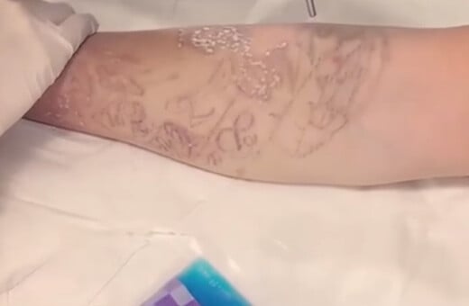 Ο τρόπος που αφαιρείται το τατουάζ από το δέρμα