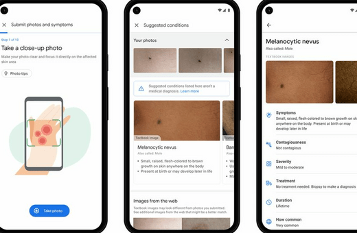 Google: Εργαλείο με τη χρήση τεχνητής νοημοσύνης μπορεί να βοηθήσει ασθενείς να αναγνωρίσουν δερματικές παθήσεις
