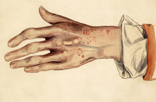 PSORIASIS