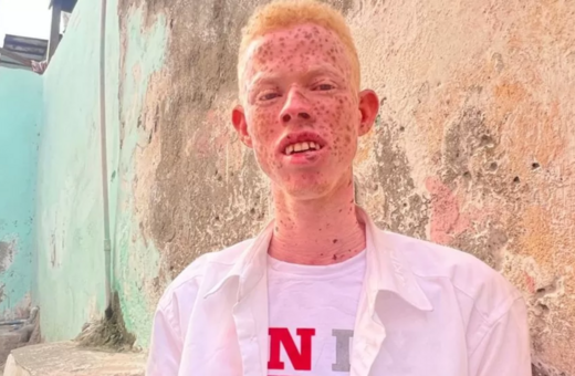 «Μου λένε ότι είμαι κανίβαλος, ότι θα φάω τα παιδιά τους»- Η εξομολόγηση ενός Σομαλού αλμπίνο