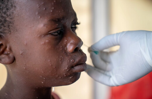 Γιατί τα εμβόλια για την mpox δεν διατίθενται στην Αφρική παρά την απεγνωσμένη ανάγκη;