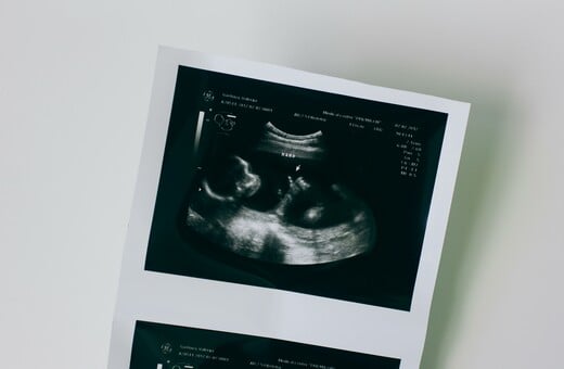 Εγκυμοσύνη: Αναπτύχθηκε τεστ για τον εντοπισμό γυναικών με αυξημένο κίνδυνο αποβολής