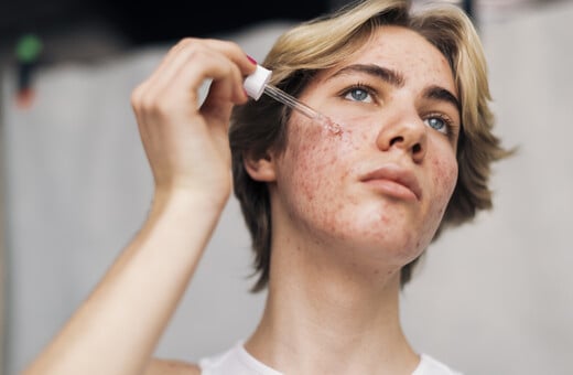 Έρχεται εμβόλιο κατά της ακμής με τεχνολογία mRNA