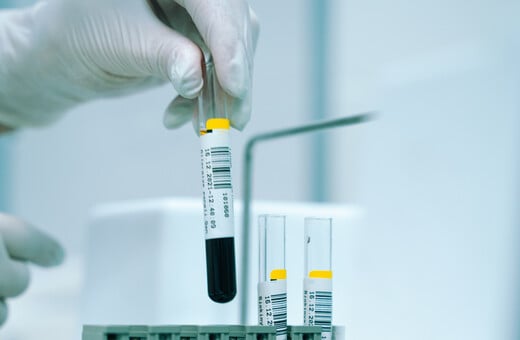 Νέα επαναστατική εξέταση αίματος δίνει ελπίδες για έγκαιρη διάγνωση 50 μορφών καρκίνου