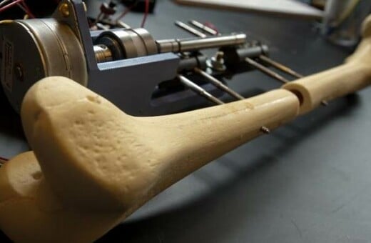 Επιμήκυνση ποδιών στην Τουρκία: Το νέο ακραίο trend της αισθητικής