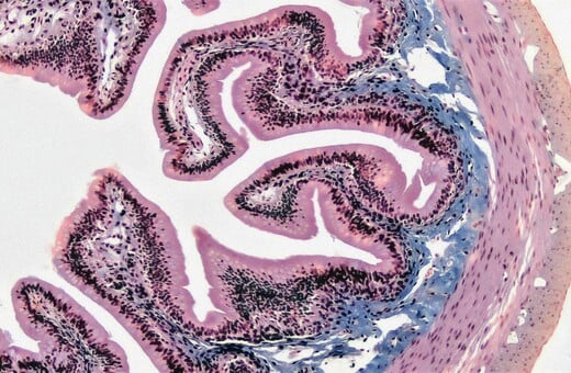 Κατανάλωση UPFs τροφίμων και καρκίνος του εντέρου: Τι δείχνει νέα μελέτη