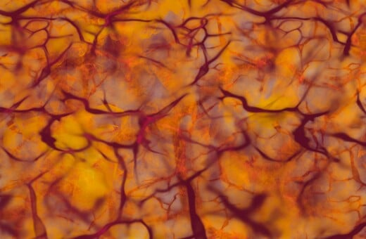 ΙΣΩΣ ΓΙΑ ΣΚ - Σκλήρυνση κατά πλάκας: Ανακαλύφθηκαν δύο υποτύποι με τη βοήθεια της τεχνητής νοημοσύνης 