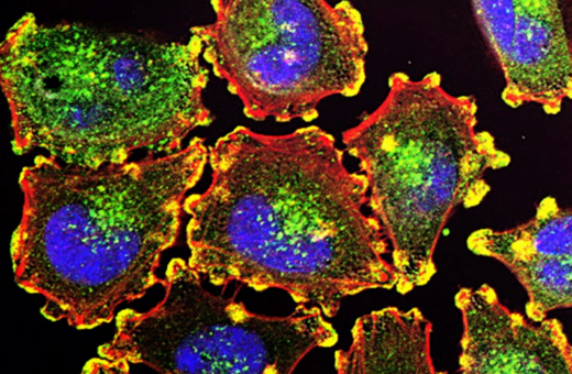 ΚΑΡΚΙΝΟΣ ΟΥΡΟΔΟΧΟΣ ΚΥΣΤΗ ΑΧΡΩΜΑΤΟΨΙΑ