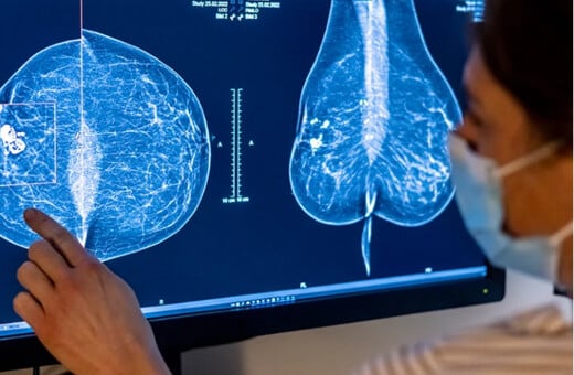 ΚΑΡΚΙΝΟΣ ΜΑΣΤΟΥ ΘΕΡΑΠΕΙΑ